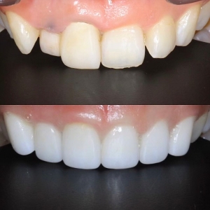  上6本 オールジルコニアの症例