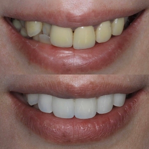  上5本 今クリアートダイヤモンドセラックの症例