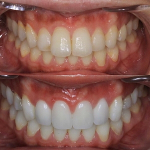  上4本 今クリアートダイヤモンドセラミックの症例